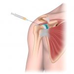 shoulder receiving steroid injection