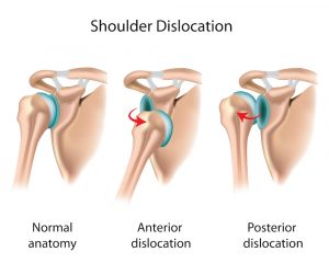 types of shoulder dislocation